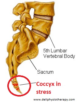 coccydynia